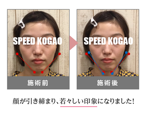 公式】Speed小顔（スピード小顔） | 多数のモデル・芸能人さんも通う小顔サロン。理論・技術も本物！