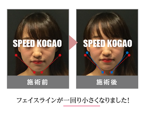 【公式】Speed小顔（スピード小顔） | 多数のモデル・芸能人さんも通う小顔サロン。理論・技術も本物！